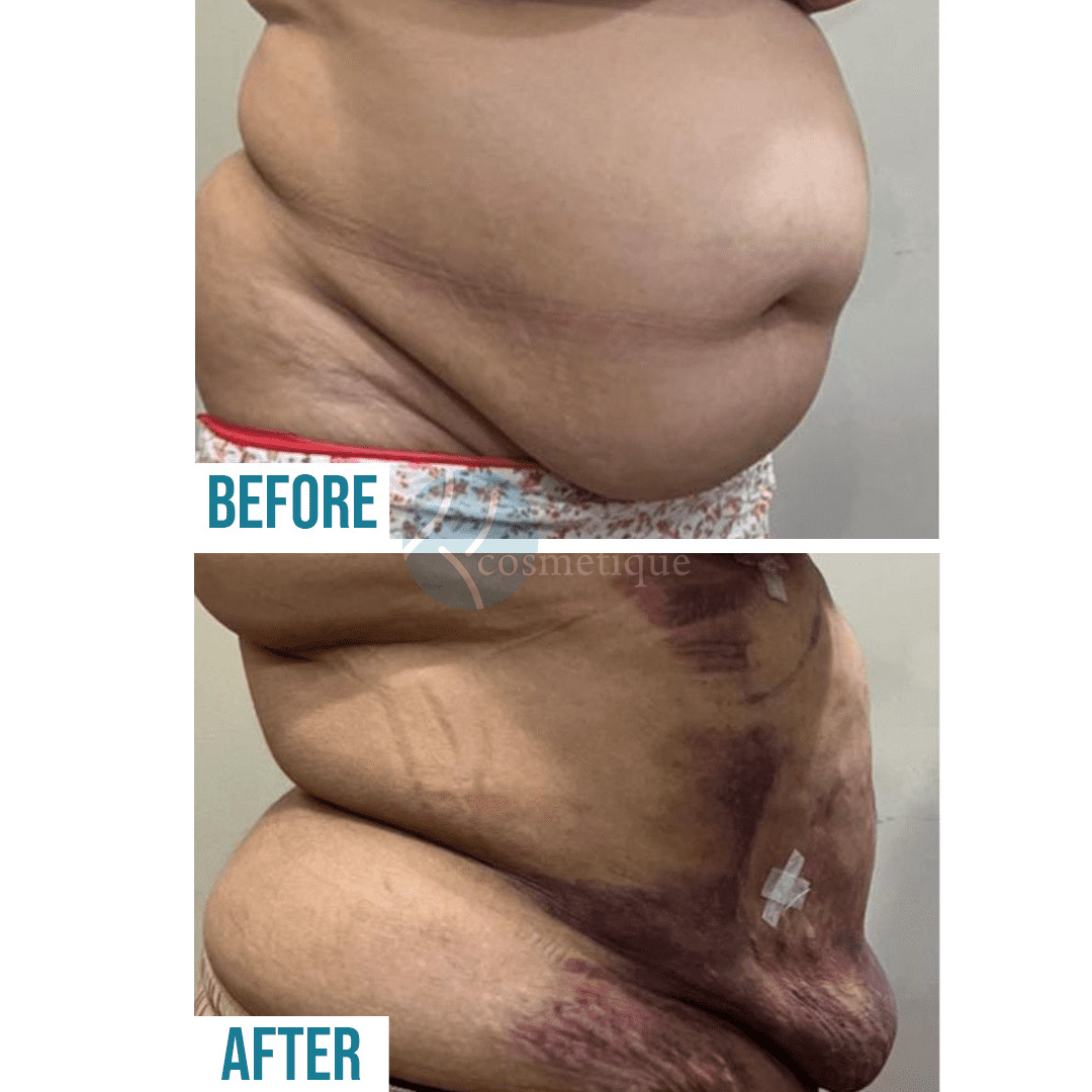 belly surgery of Liposuction in Lahoree