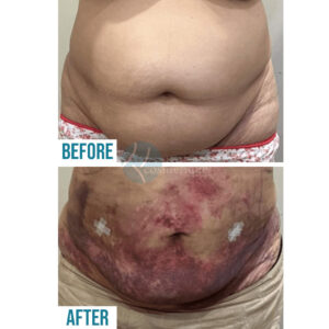 belly surgery of liposuction