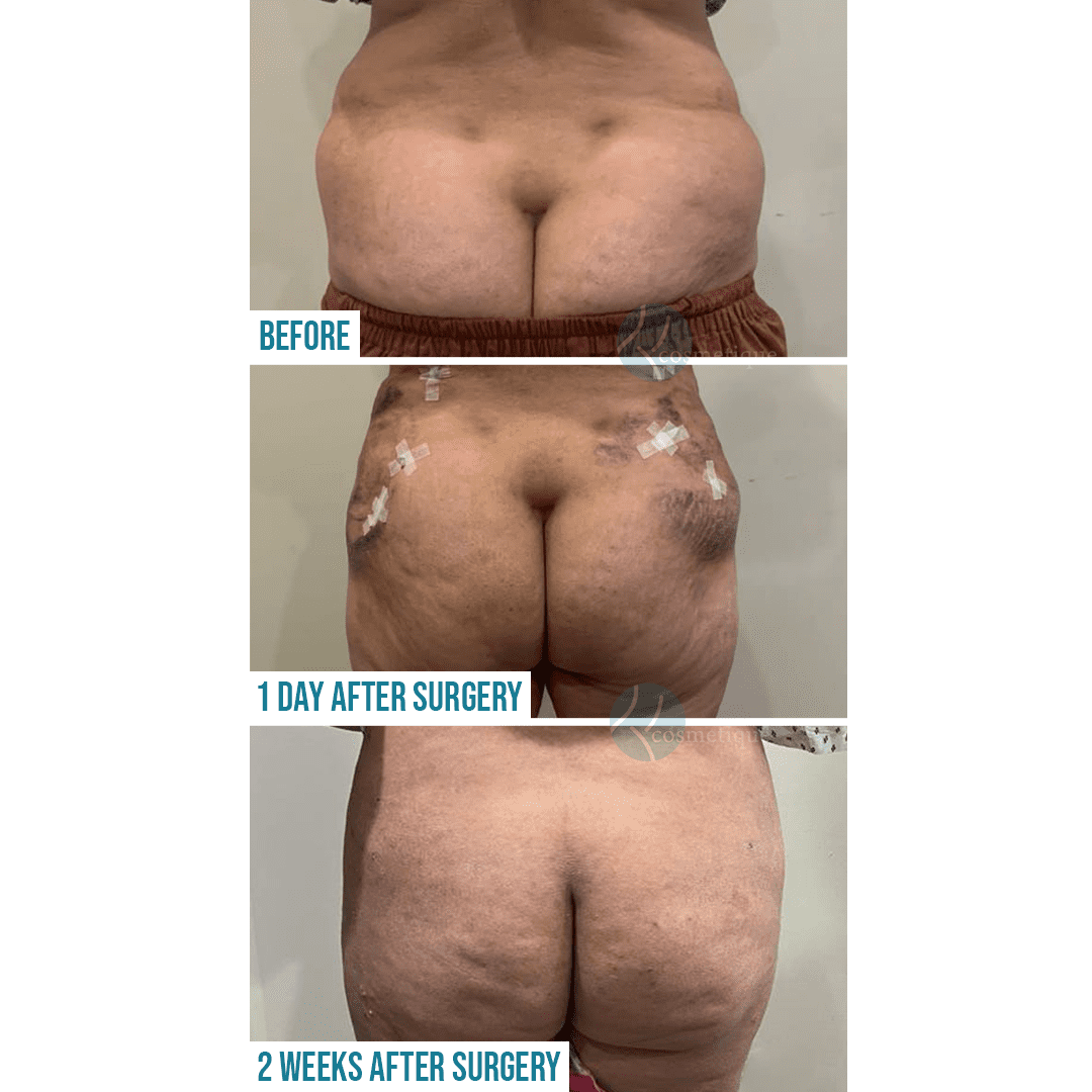 Lipo treatment before and after