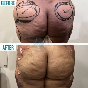 hip liposuction before and after pic