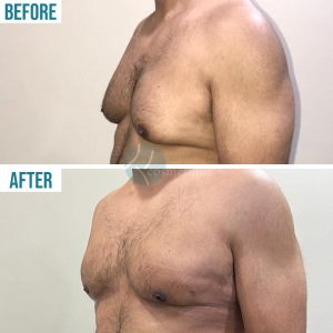 Liposuction gynecomastia surgery