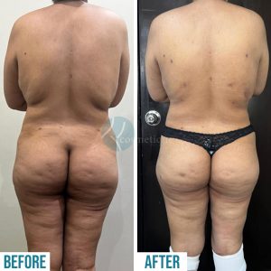 back and Leg Liposuction before and after