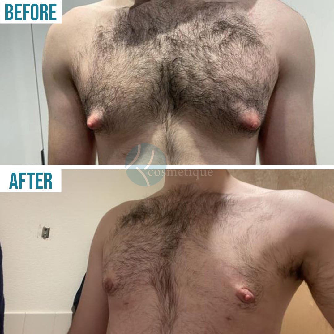 gynecomastia surgery before and after real time