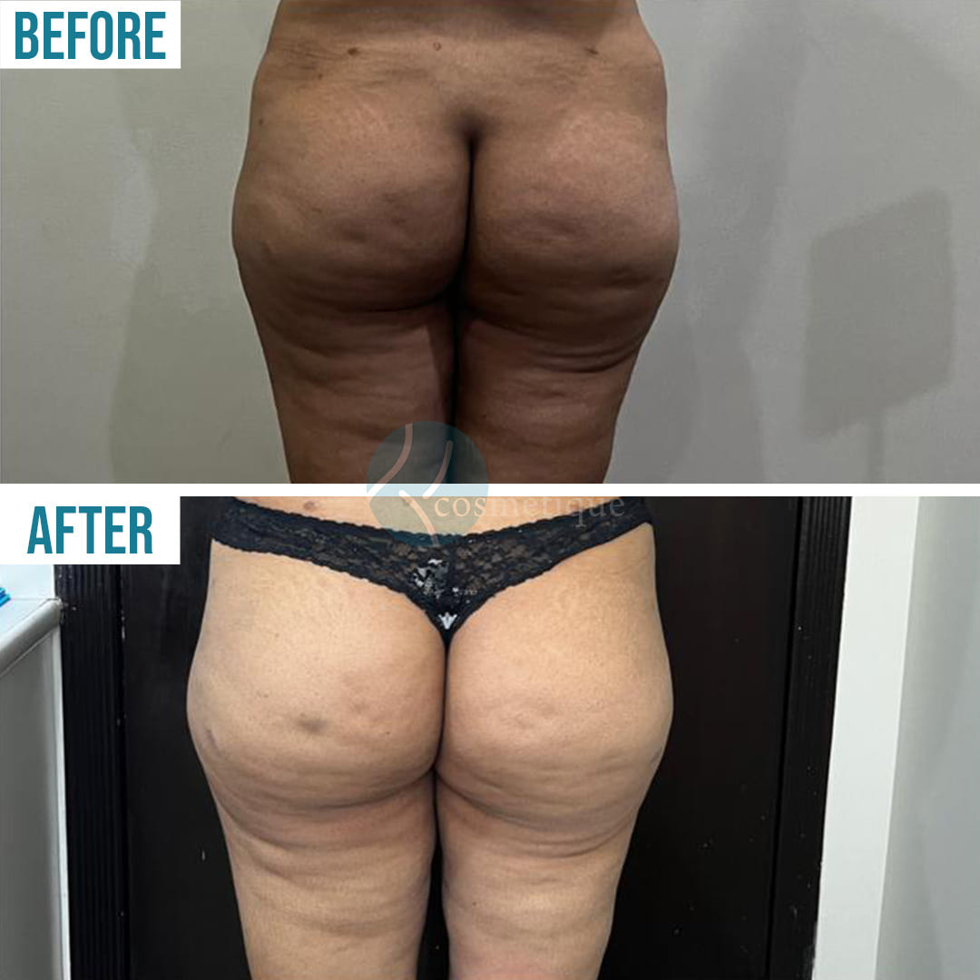 Back Lipo at beforea and after fill result