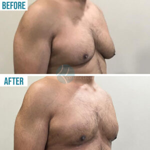 chest liposuction surgery