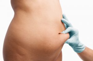 liposuction in Lahore without anesthesia