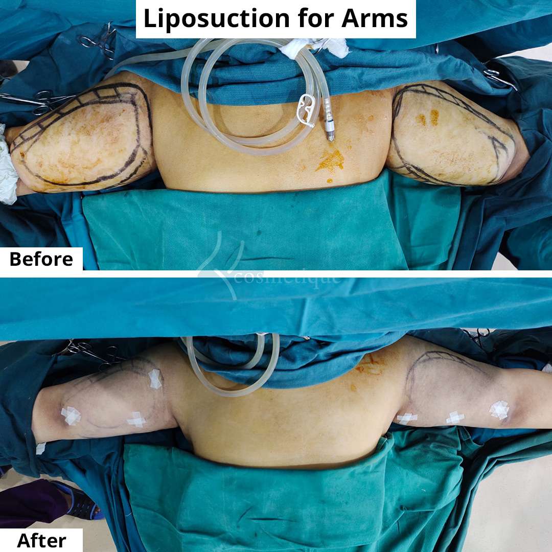 Arms Liposuction 2