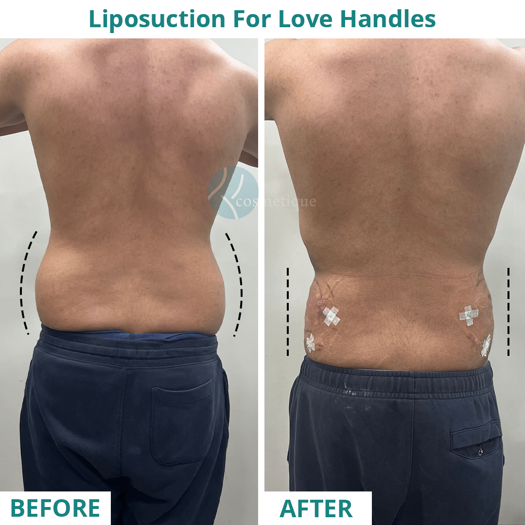 Liposuction Back Before After