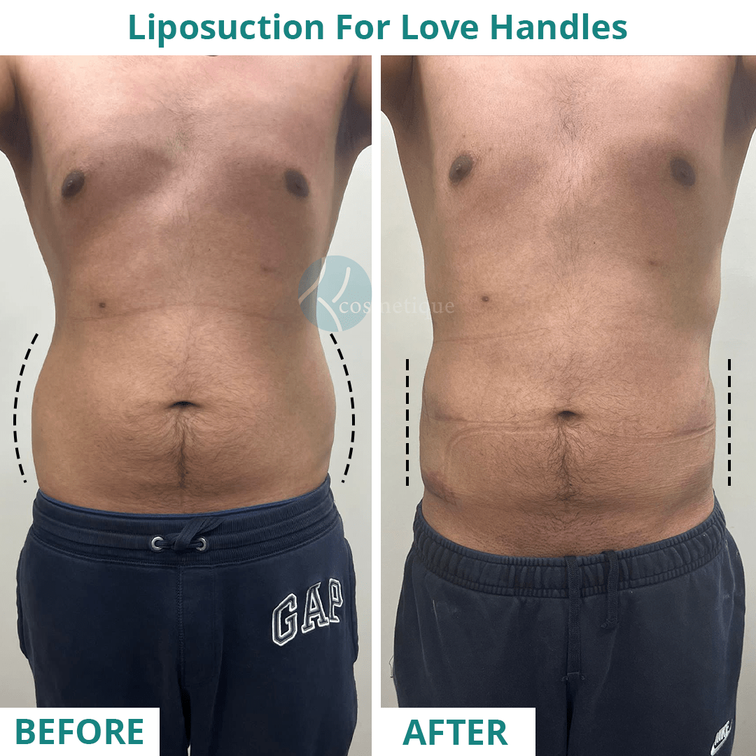 Liposuction Front Before After